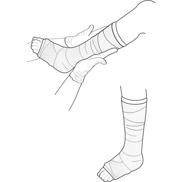 Vector illustration of leg cast examination