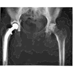Hip replacement Image 3684 PH 2016122041