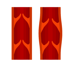 Varicose and normal vein